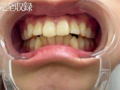 【素人・口腔フェチ】裏側矯正＋美女素人高身長ラウンドガール18歳。高額オファーでガチ交渉。検診記録を初公開。